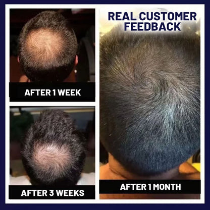 HZA™ Natuurlijke Haargroei Spray